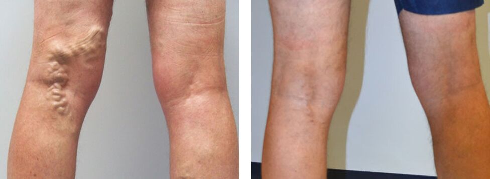 Foto antes e despois de usar Veniselle, experiencia no uso de crema