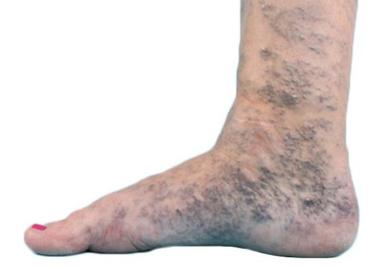 Varices nas pernas