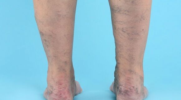 Enfermidade varicosa