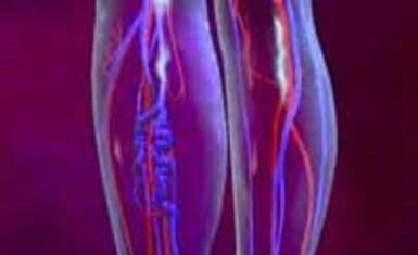 Causas e tratamento das varices