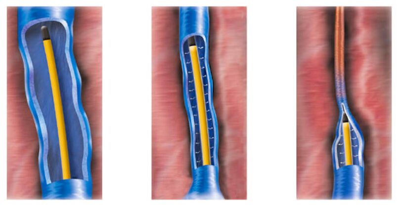 ablación por radiofrecuencia como método de tratamento de varices