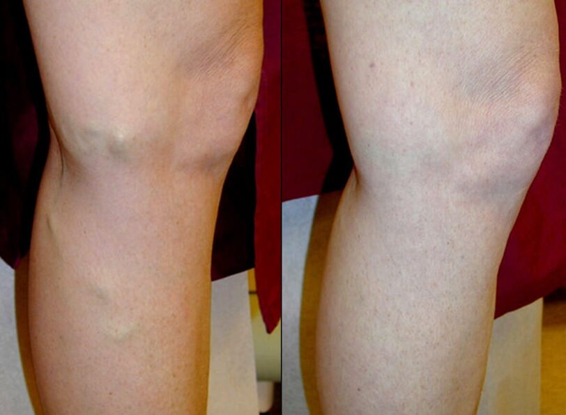 métodos de tratamento de varices nas pernas