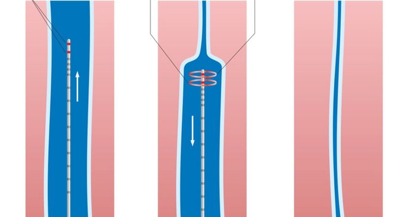 tratamento con láser para varices nas pernas
