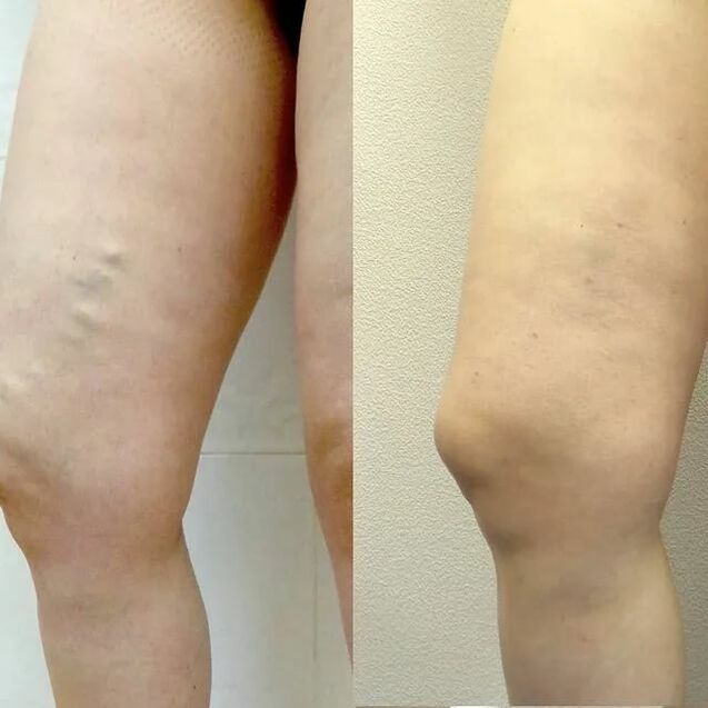 antes e despois do tratamento de varices